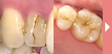 歯にある黒い線は汚れ？虫歯？ご説明します