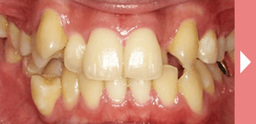 歯の黄ばみの原因と治療方法