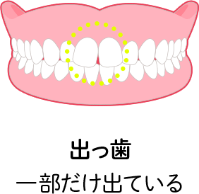出っ歯